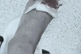 血染纱布！TVB人气女星吴嘉仪不慎被刀插伤：紧急留医骨科缝六针图片