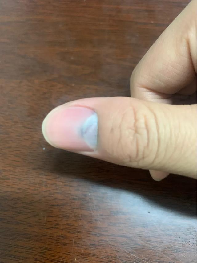 指甲盖被砸了有瘀血怎么办