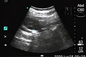 37岁，右肾盂积水，输尿管扩张伴结石…中医1剂药方，利尿排石图片
