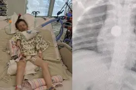 女儿突然暴瘦，拍片时医生让摘下项链，宝妈疑惑：我女儿没戴项链图片