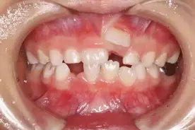 吓人的“双排牙宝宝”越来越多，跟家长的一个坏习惯有关，早点改图片