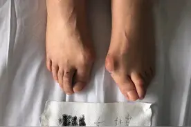 退休大姐跳完广场舞，大脚趾竟痛到没法穿鞋！这个病专害女人图片