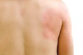 漫谈“芷防汤”治荨麻疹图片