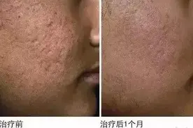 3岁男娃被鸡抓烂脸，伤口竟“长出”鸡趾甲！爸妈后悔没早做这事图片