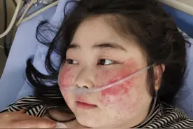 穿古装跳舞胖女孩住院！血小板变少全身出血，医生已下病危通知书图片