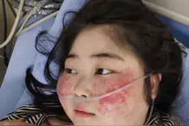 穿古装跳舞胖女孩住院！血小板变少全身出血，医生已下病危通知书图片