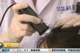 发际线越来越高该咋办？洗发水、生发仪真能有效治疗脱发？别被骗了图片