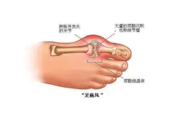 出现这四大症状，可能已患痛风，预防要做好10项措施图片
