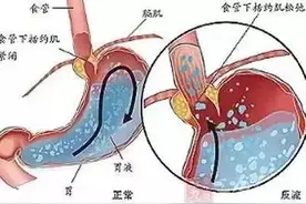 狡猾的“伪装者”——胃食管反流病（GERD)图片