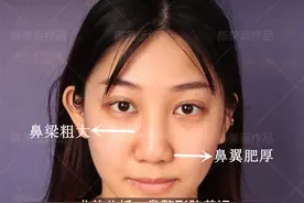 线雕隆鼻失败重获精致美鼻是一种什么体验？来看看莹莹的修复之路图片