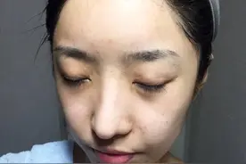 毛孔油脂分泌过多，造成堵塞毛囊形成痘痘怎么办图片