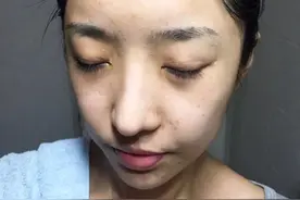 毛孔油脂分泌过多，造成堵塞毛囊形成痘痘怎么办图片