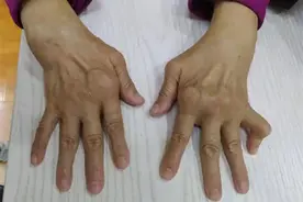 治疗类风湿传统单一药物不可取，联合诊治才能避免关节变形图片