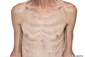 老年人什么原因会消瘦？图片