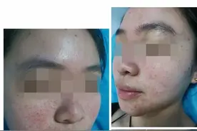 面部泛红起脓疱疹反复2年余，原来患的不是痤疮，而是玫瑰痤疮图片
