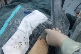 女子患有肾结石，本以为是个小手术，谁知医生竟在术中就开始抢救图片