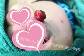 唇上长颗“小樱桃”，无意中触碰流血止不住，“老母亲”惊出一身冷汗图片