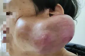 3小时摘除女子左腮巨大肿物图片