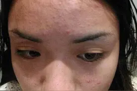 夏天长痘痘其实不用怕，你在找的祛痘方法这里都有，值得收藏图片