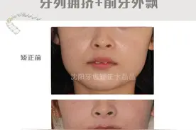 沈阳牙齿矫正：门牙前突矫正会改变脸型吗？图片