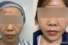 面部年轻化总结7个主要术式方案，面部松弛下垂衰老的姐妹可参考图片