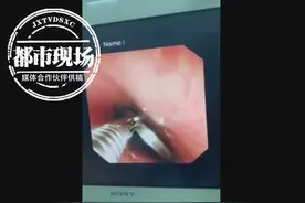 1岁宝宝吃啥吐啥，一检查吓坏了！有东西卡在食管近20小时图片