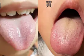 三招教会你看孩子舌苔图片