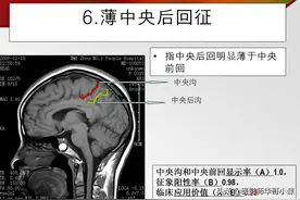 磁共振（MRI）脑沟、脑回十大征象定位体系- 精品图集图片