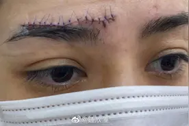 阿娇首晒受伤照，超长伤口触目惊心！疤痕或许还需靠医美解决？图片