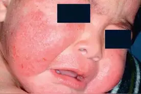 夏季婴儿湿疹反复，儿科医师几段话说清正确的护理和治疗图片