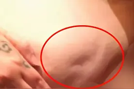 乳房上长了一个“小酒窝”是怎么回事？图片