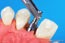 你问我答2：种植牙是缺几颗种几颗吗？一次能“种”几颗牙？图片