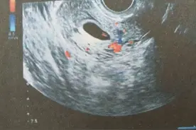 试管婴儿经验贴之移植开奖日：HCG升高，验孕棒双杠图片