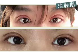 真人分享 我割完双眼皮，漂亮了10000倍图片