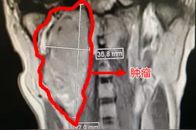 一台15小时的接力手术，切除患者9公分的脑瘤，家属赋离骚体古诗感谢图片