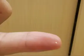 哺乳期小白点堵奶，千万别去挑图片