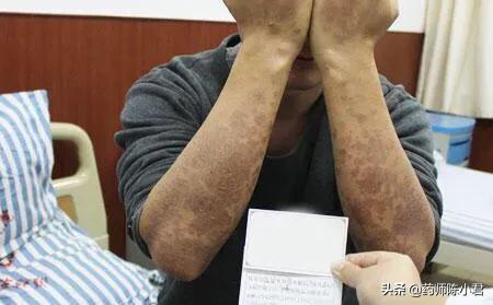 薄膜现象是角化不全