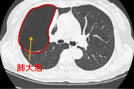 不可逆，无法用药物根治，有这种生活习惯的人基本都有肺大泡图片