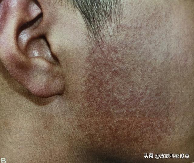 这几天熬夜手臂鸡皮疙瘩