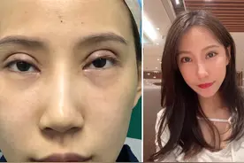 一场失败的双眼皮手术，使19岁少女容貌畸形，生活停顿，恳求急救图片