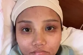 陕西一女子顺产后状态吓人，疼到满脸皮下出血，与生产前判若两人图片