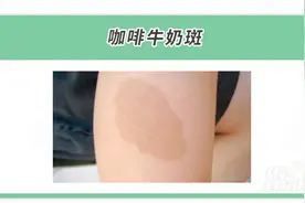 从发病到去世不到2月！警惕！这5种胎记和痣会危及娃生命图片