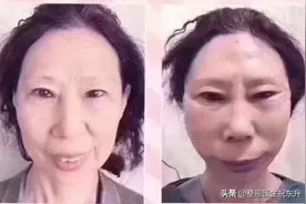 奔着年轻去做的大拉皮，怎么脸还“垂”得更快了？图片