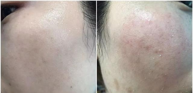 去粉刺毛囊炎痤疮鸡皮身体乳