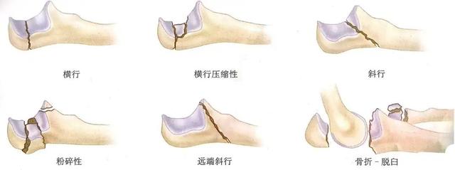 鹰嘴骨折多久能好（尺骨鹰嘴骨折的正确处理方式及相关注意事项）