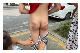 全身多处淤青、闭合性颅脑损伤！11岁男孩被辅导班老师用教具殴打，母亲心痛：咋能下这么狠的手？图片