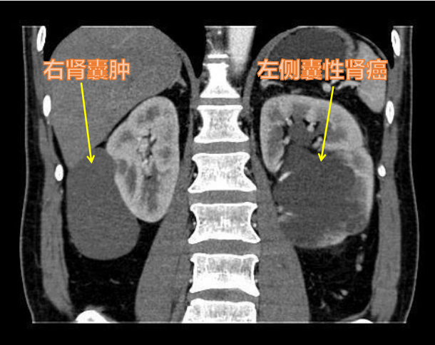 肾囊肿>5 cm不必马上手术，但囊性肾癌无论大小，都应尽快切除