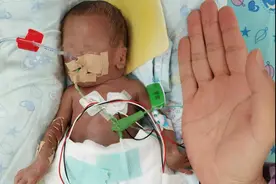 24周早产，肠子被切掉！早产宝宝，一出生就得“打仗”图片