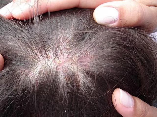 头皮出现这4种症状要注意,是身体对你的警告,教你5个对策解决