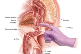 训练盆底肌可以改善前列腺炎？图片